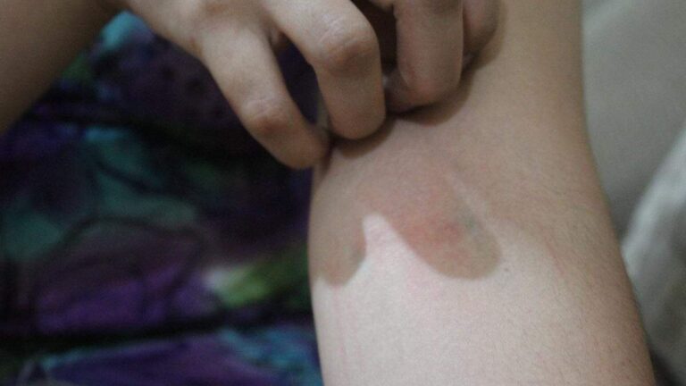 Sonora encabeza casos acumulados de dengue en 2026 con 946 contagios confirmados